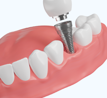 implantaciya-zubov-1.jpg