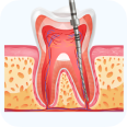 Лечение каналов зубов