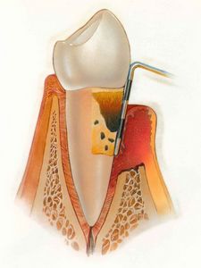 Лечение периодонтита