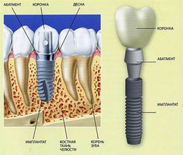 implantaciya-zubov-v-omske-shema.jpg