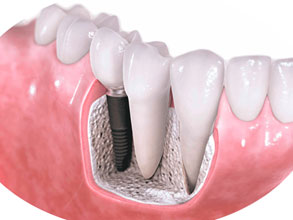 implantaciya-zubov-1.jpg