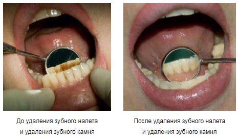 udalenie-zubnogo-kamnya.jpg