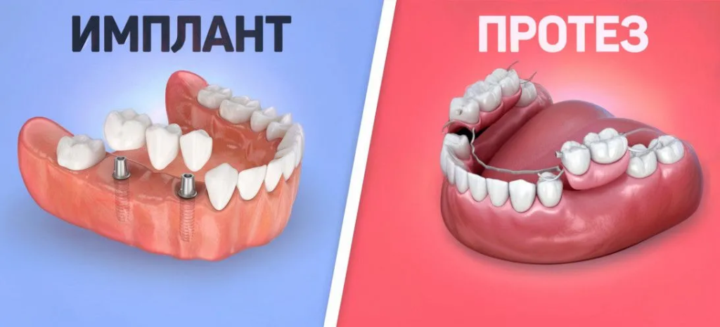 Что дешевле: имплантация или протезирование зубов