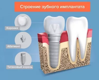 implant-zubnoi.jpg